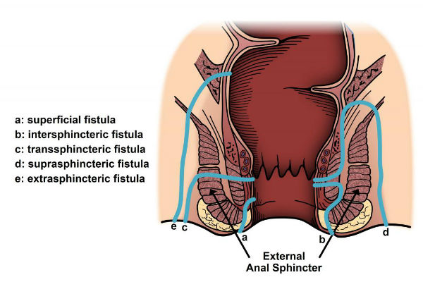 types of fistula