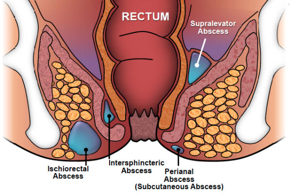 perianal abscess